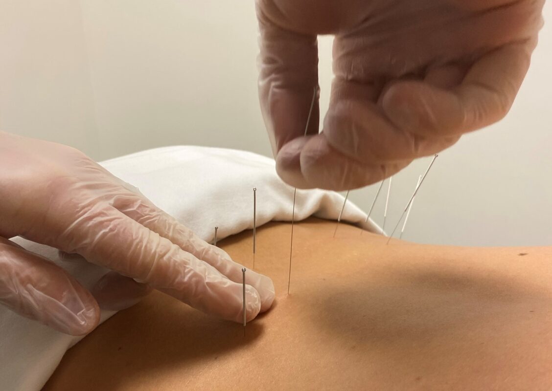 Dry Needling in Physical Therapy